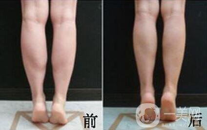 *注射瘦小腿*果怎么樣？