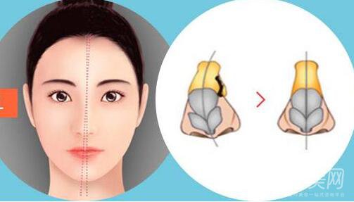 歪鼻矯正手術(shù)多少錢(qián)？