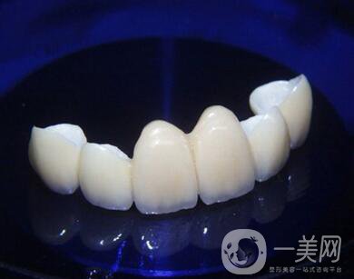 金鈀合金烤瓷牙價格多少錢？