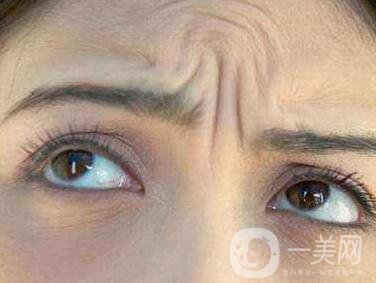 抬頭紋能消除嗎？有哪些方法？