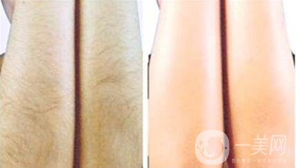 彩光脫毛會(huì)不會(huì)有副作用？