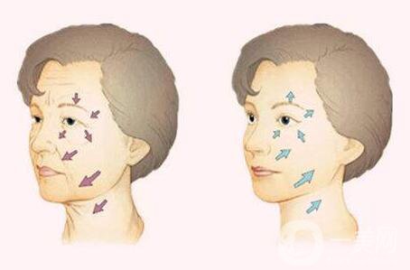 等離子除皺副作用有哪些？