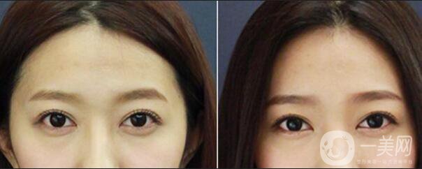 北京自體脂肪豐眉弓多少錢