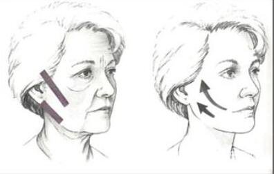 上海,除皺,多少錢(qián)