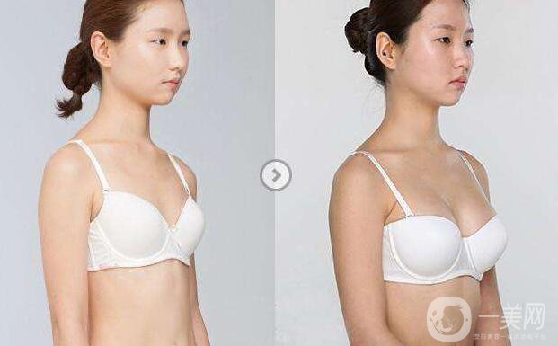 北京,妙姚假體,隆胸,需要多少錢