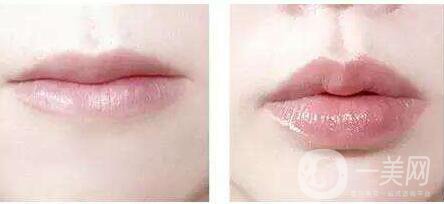 廣東,玻尿酸豐唇,價錢