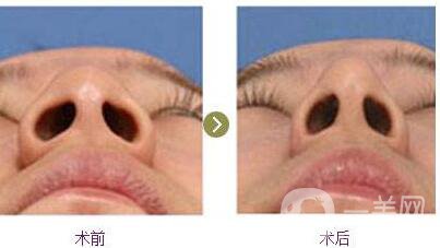 廣東,縮小鼻翼手術(shù),需要多少錢