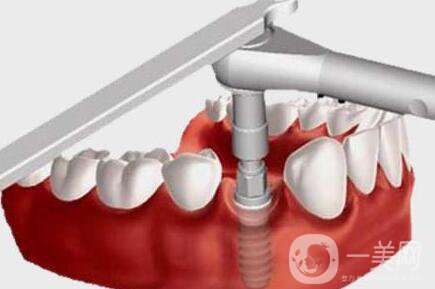 上海,人工種植牙,價(jià)格