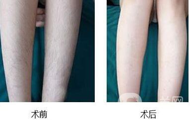 激光脫毛,北京激光脫毛,介紹