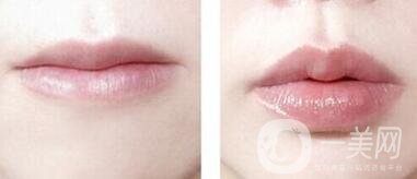 非手術(shù)豐唇方法具體有哪些