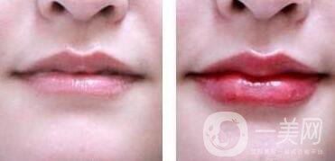非手術(shù)豐唇方法具體有哪些