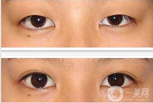 割雙眼皮,后遺癥,上海割雙眼皮