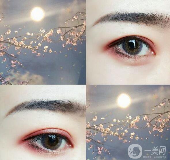 割雙眼皮,后遺癥,上海割雙眼皮