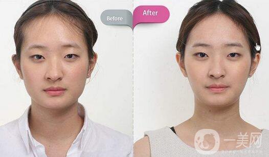 磨骨多少錢？磨骨價(jià)格盤點(diǎn)！