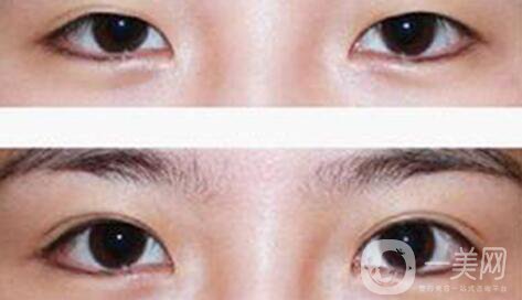 疤痕皮膚能割雙眼皮么 會(huì)有影響嗎