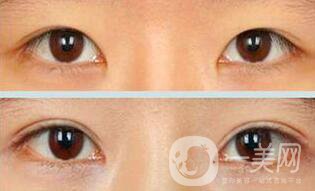 疤痕皮膚能割雙眼皮么 會(huì)有影響嗎