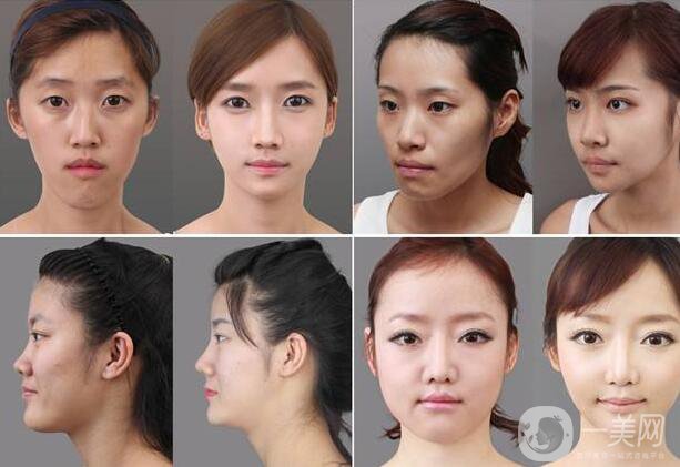 北京顴骨手術(shù)要多少錢？