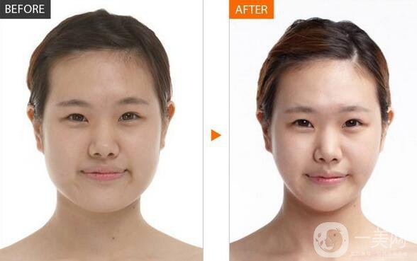 北京顴骨手術(shù)要多少錢？