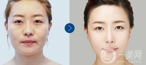 像素激光,美白嫩膚,怎么樣,副作用