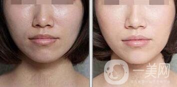 光子嫩膚介紹?成都光子嫩膚醫(yī)院介紹