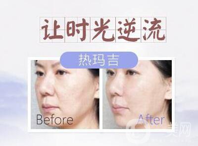 塑美極的副作用有哪些？