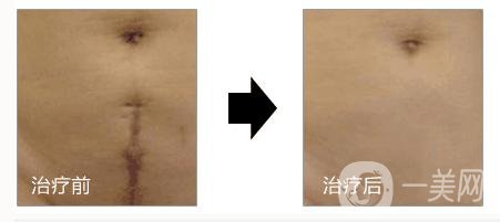 上海做一次像素激光去疤痕手術(shù)調(diào)節(jié)多少錢