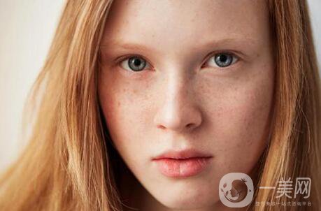 黃褐斑能用激光去除嗎？