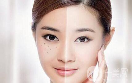 黃褐斑能用激光去除嗎？