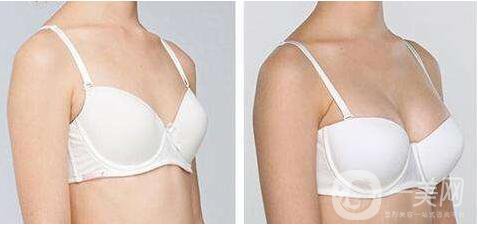 杭州,妙桃假體,隆胸,缺點