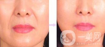 上海注射伊維蘭除皺花多少錢