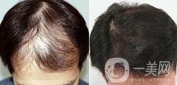 鄭州植發(fā)醫(yī)院信息介紹？植發(fā)去介紹