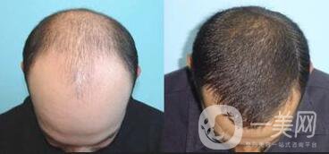 鄭州植發(fā)醫(yī)院信息介紹？植發(fā)去介紹