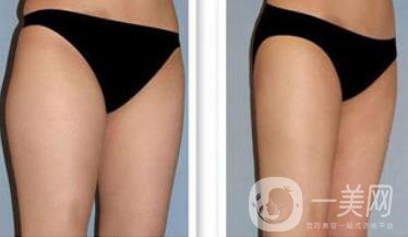 吸脂*嗎？吸脂手術(shù)有風(fēng)險(xiǎn)嗎