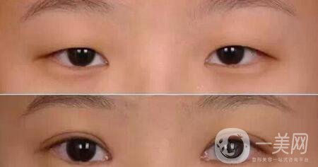 開眼角割雙眼皮整形手術*果怎么樣