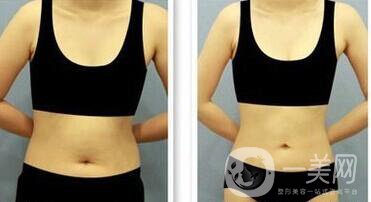 腰腹吸脂手術(shù)主要適合哪些人做 