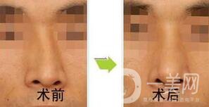 歪鼻矯正需要恢復(fù)多久？術(shù)后需要注意什么