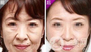 小切口面部提升*果怎么樣？會不會留疤