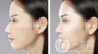 墊下巴用什么材料好？墊下巴改良臉型*果