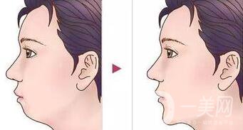 墊下巴用什么材料好？墊下巴改良臉型*果