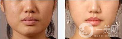 墊下巴用什么材料好？墊下巴改良臉型*果