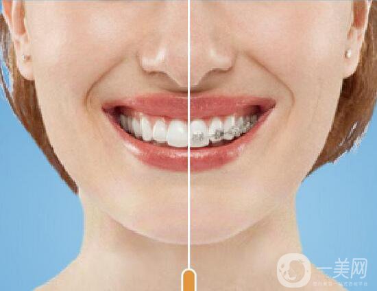 t4a矯正牙齒,怎么樣