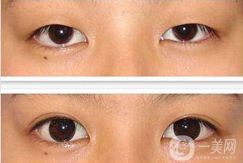 亞韓,割雙眼皮,多少錢