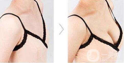 廣東,隆胸,價格