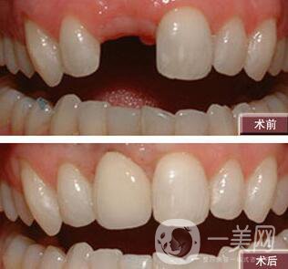 種植牙有什么優(yōu)點？北京種植牙介紹?