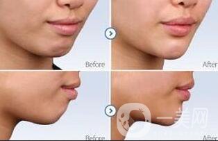 上海玻尿酸墊下巴多少錢(qián)