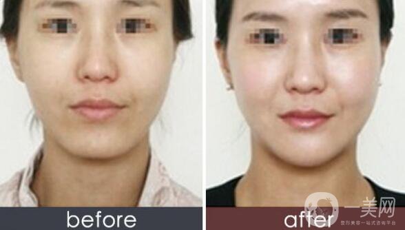 上海玻尿酸墊下巴多少錢(qián)