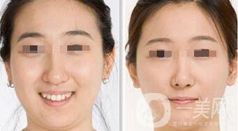 激光溶脂和吸脂的區(qū)別都有什么