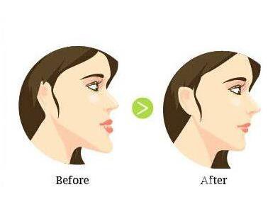 地包天,廣東地包天整形,廣東地包天整形多少錢(qián),地包天矯正價(jià)格分析