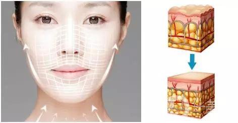 等離子除皺怎么樣 有些什么危害