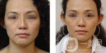 拉皮手術(shù)的方法有哪些?成都拉皮手術(shù)一般多少錢